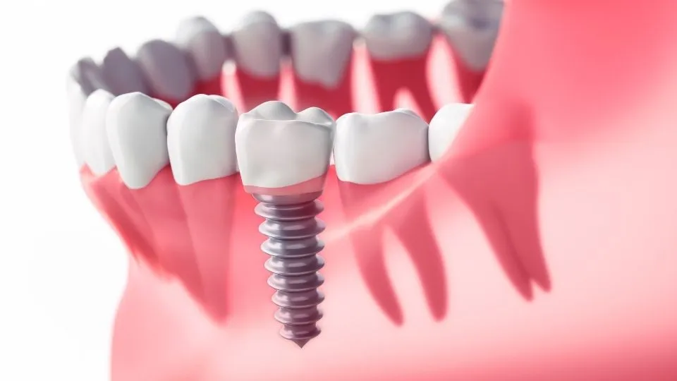 dental implants