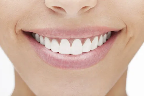 veneers