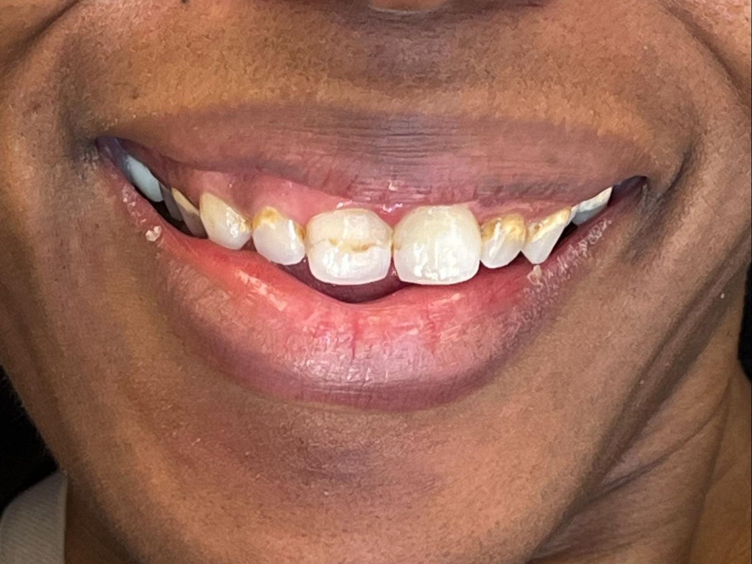 Before dental treatment