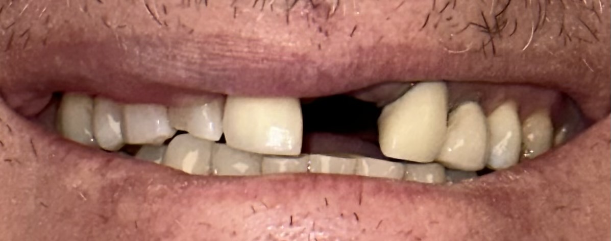 Before dental treatment