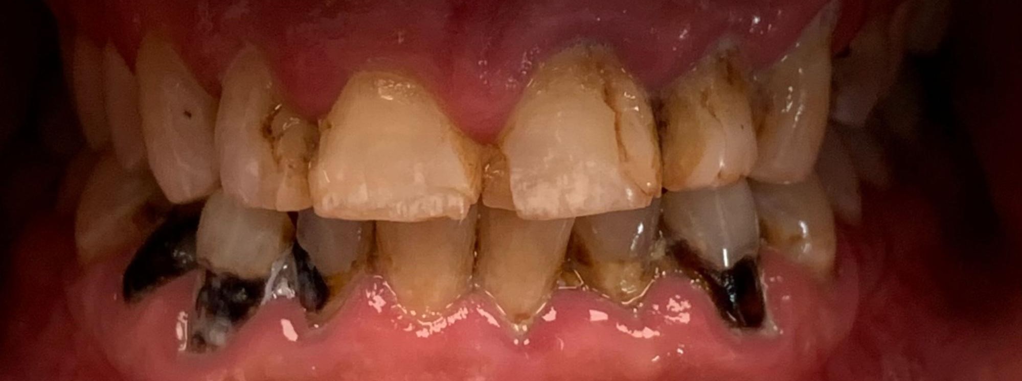 Before dental treatment