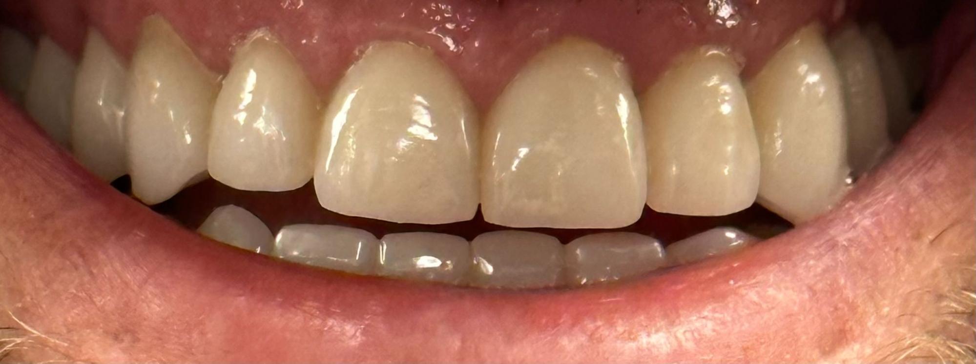 After dental treatment