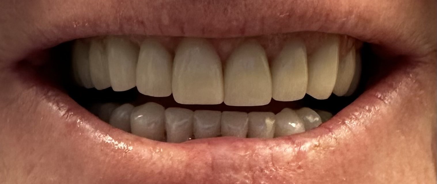 After dental treatment