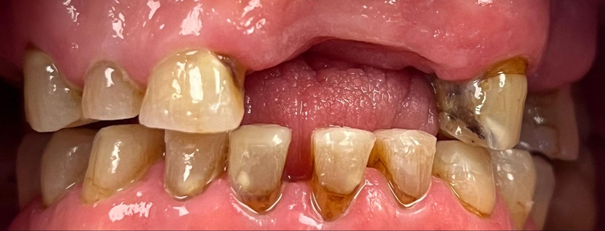 Before dental treatment